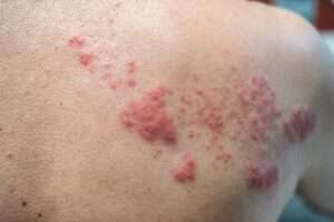Shingles (disease), Herpes Zoster, Varicella Zoster Virus. Skin